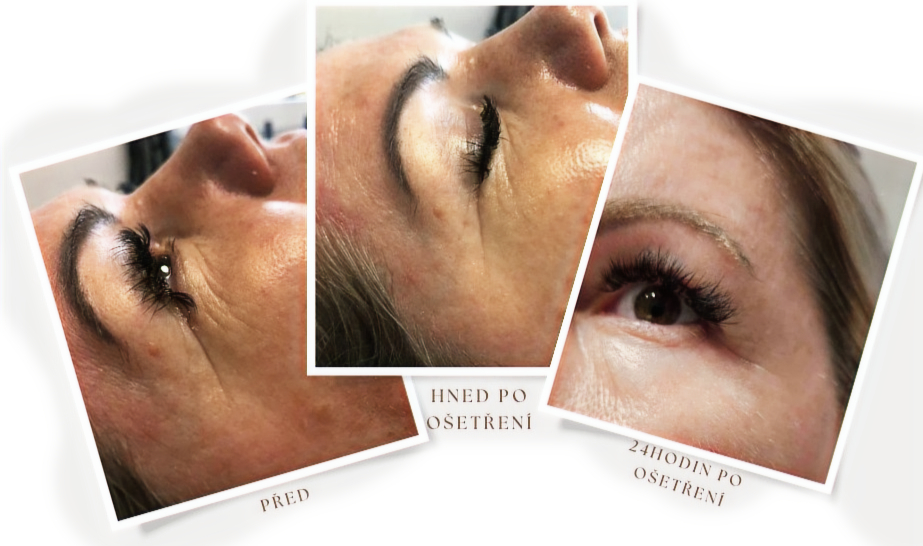 Niťový kolagenový lifting